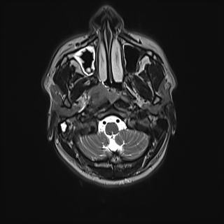 Nasopharyngeal carcinoma with perineural spread (Radiopaedia 55030-61380 Axial T2 28).jpg