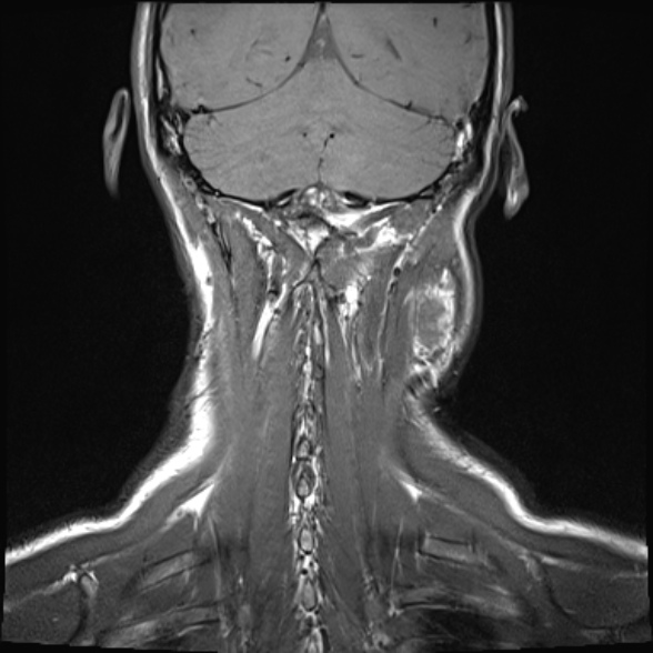 Nasopharyngeal carcinoma with skull base invasion (Radiopaedia 53415-59485 Coronal T1 3).jpg