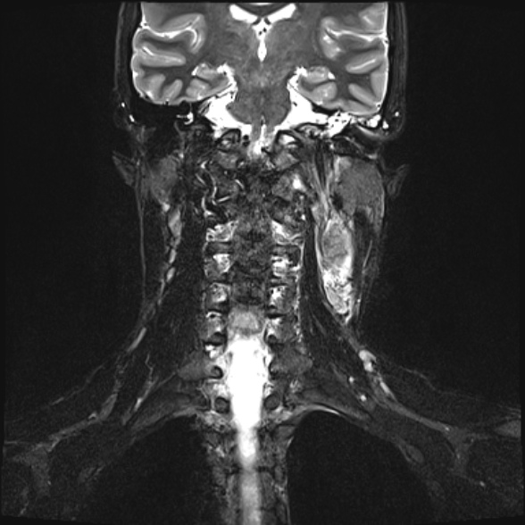Nasopharyngeal carcinoma with skull base invasion (Radiopaedia 53415-59485 Coronal T2 fat sat 11).jpg