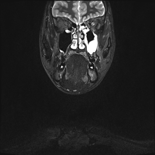 Nasopharyngeal carcinoma with skull base invasion (Radiopaedia 53415-59485 Coronal T2 fat sat 31).jpg
