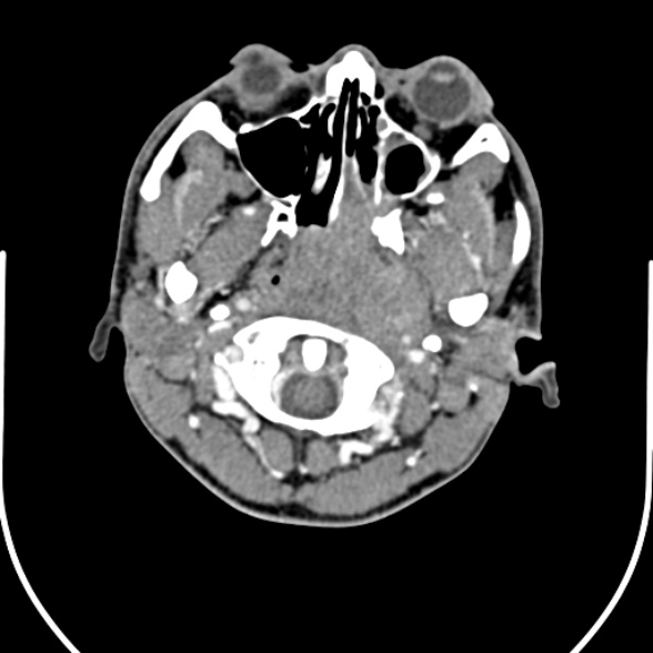 Nasopharyngeal carcinoma with skull base invasion (Radiopaedia 53415-59705 A 40).jpg