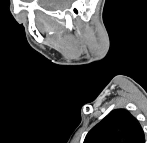 Nasopharyngeal carcinoma with skull base invasion (Radiopaedia 53415-59705 C 63).jpg