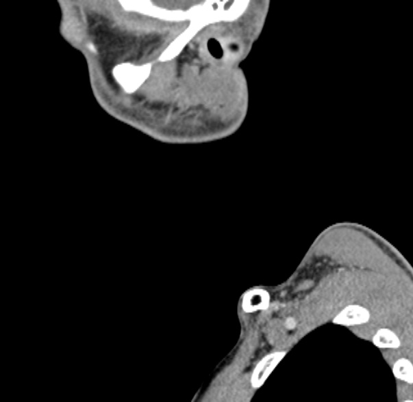 Nasopharyngeal carcinoma with skull base invasion (Radiopaedia 53415-59705 C 69).jpg