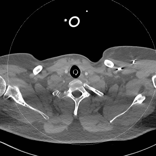 Neck CT angiogram (intraosseous vascular access) (Radiopaedia 55481-61945 B 117).jpg