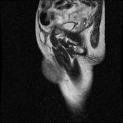 File:Necrotizing epididymo-orchitis with intra-testicular abscess (Radiopaedia 29397-29860 Sagittal T2 16).jpg