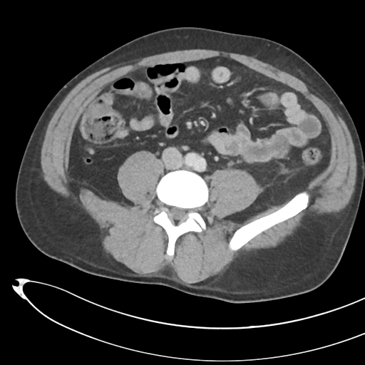 File:Necrotizing pancreatitis with acute necrotic collections (Radiopaedia 38829-41012 B 51).png