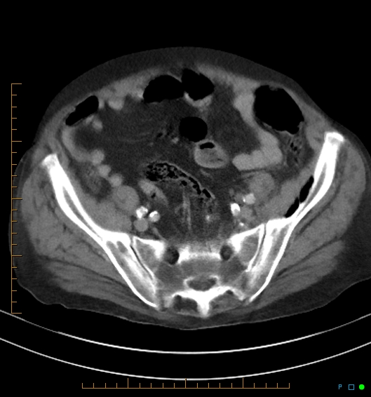 Necrotzing fasciitis due to a perforated adenocarcinoma of the splenic flexure (Radiopaedia 46930-51455 A 49).jpg