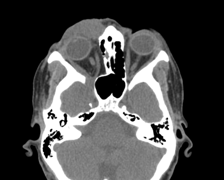 Neurofibromatosis type 1- orbital manifestations (Radiopaedia 49391-54511 Axial non-contrast 49).jpg
