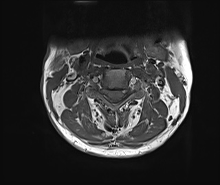 File:Neurofibromatosis type 1 (Radiopaedia 80355-93740 Axial T1 10).jpg