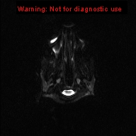 File:Neurofibromatosis type 1 with optic nerve glioma (Radiopaedia 16288-15965 Axial DWI 22).jpg