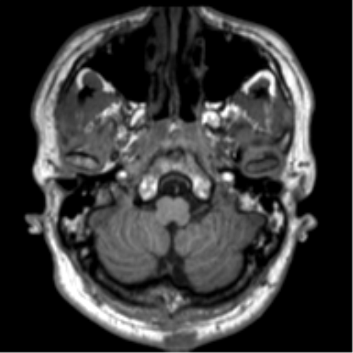 File:Neurofibromatosis type 2 (Radiopaedia 44936-48838 Axial T1 15).png