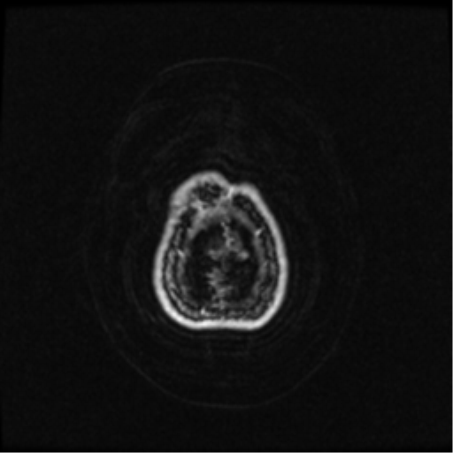 Neurofibromatosis type 2 (Radiopaedia 45229-49244 Axial T1 C+ 112).png