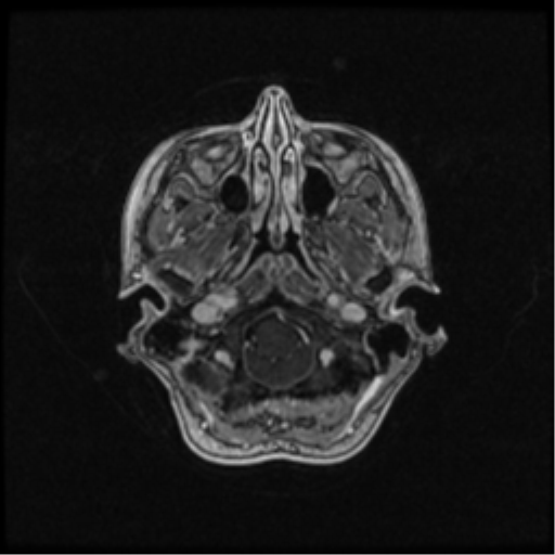 Neurofibromatosis type 2 (Radiopaedia 45229-49244 Axial T1 C+ 29).png