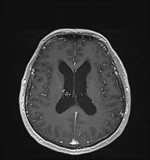 Neurofibromatosis type 2 (Radiopaedia 79097-92049 Axial T1 C+ 118).jpg