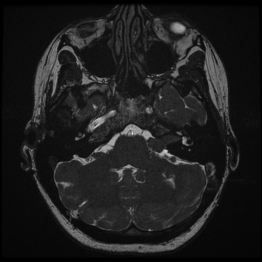 File:Neurofibromatosis type 2 - bilateral acoustic neuromata (Radiopaedia 40060-42566 Axial FIESTA 32).png