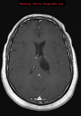 File:Neuroglial cyst (Radiopaedia 10713-11184 Axial T1 C+ 10).jpg