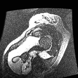 File:Non-compaction of the left ventricle (Radiopaedia 38868-41062 SAXs 60).jpg