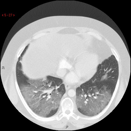 File:Non-specific interstitial pneumonitis (Radiopaedia 27044-27222 Axial lung window 18).jpg