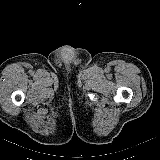 File:Non Hodgkin lymphoma in a patient with ankylosing spondylitis (Radiopaedia 84323-99621 Axial non-contrast 70).jpg