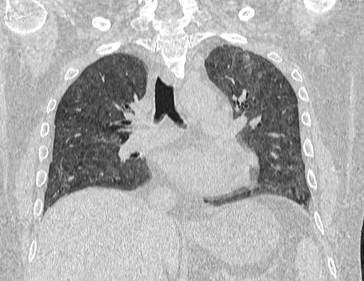 Non specific interstitial pneumonia (NSIP) (Radiopaedia 89725-106798 Coronal lung window 41).jpg