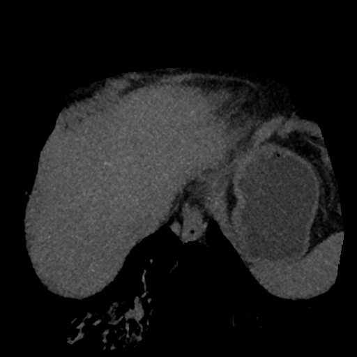 File:Normal CT intravenous cholangiogram (Radiopaedia 38199-40208 Axial IVC (MIP) 83).png