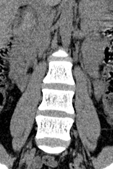 Normal CT lumbar spine (Radiopaedia 53981-60118 F 20).jpg