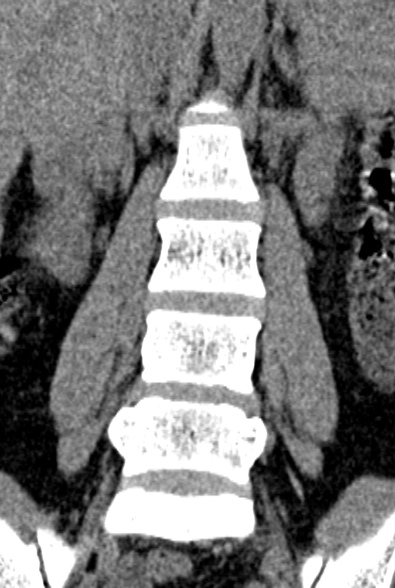 Normal CT lumbar spine (Radiopaedia 53981-60118 F 29).jpg