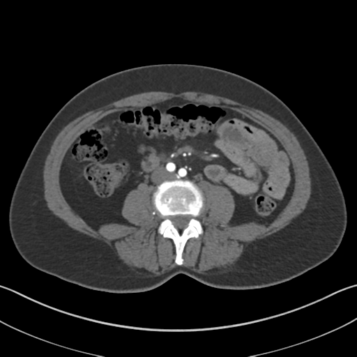 File:Normal CT renal artery angiogram (Radiopaedia 38727-40889 A 58).png