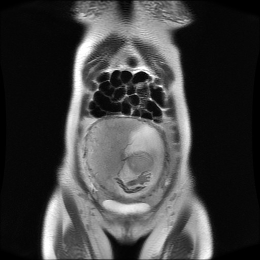 File:Normal MRI abdomen in pregnancy (Radiopaedia 88001-104541 Coronal T2 8).jpg