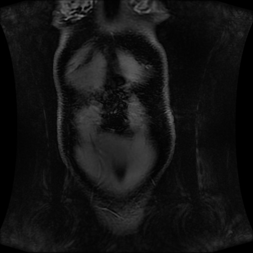 Normal MRI abdomen in pregnancy (Radiopaedia 88001-104541 M 26).jpg