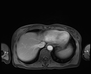 Normal adrenal glands MRI (Radiopaedia 82017-96004 M 11).jpg