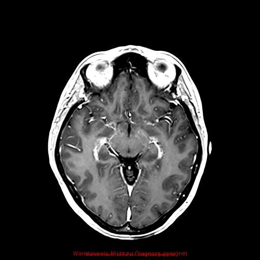 Normal adult brain MRI (non-enhanced and contrast-enhanced) (Radiopaedia 75262-86379 Axial T1 C+ 96).jpg