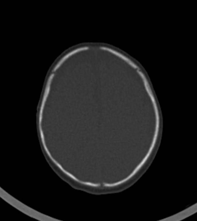 Normal brain CT - 2-month-old (Radiopaedia 53369-59350 Axial bone window 13).jpg