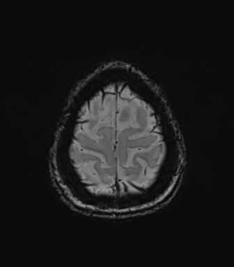 Normal brain MRI (TLE protocol) (Radiopaedia 40748-43405 Axial SWI 79).png