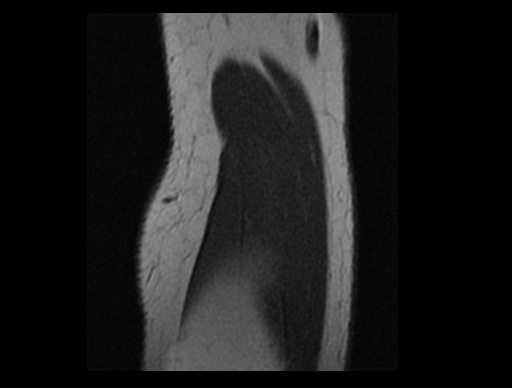 File:Normal elbow arthrograms (Radiopaedia 75550-86805 Sagittal PD 6).jpg