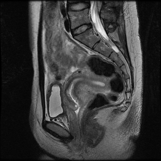 File:Normal female pelvis MRI (retroverted uterus) (Radiopaedia 61832-69933 Sagittal T2 18).jpg
