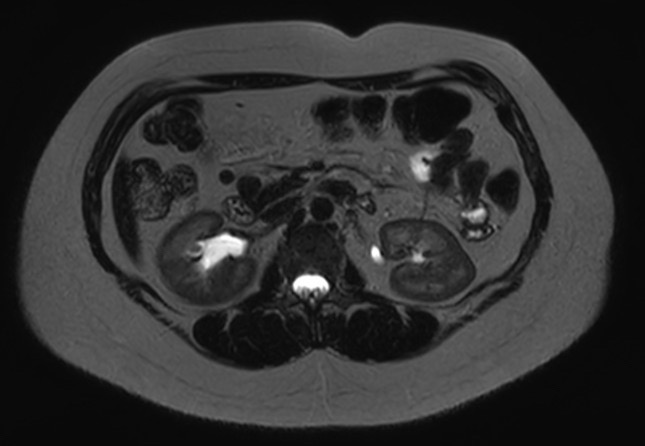 File:Normal liver MRI with Gadolinium (Radiopaedia 58913-66163 E 12).jpg