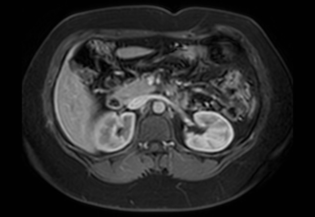 Normal liver MRI with Gadolinium (Radiopaedia 58913-66163 J 30).jpg