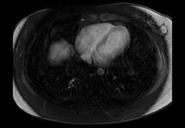 Normal liver MRI with Gadolinium (Radiopaedia 58913-66163 J 76).jpg