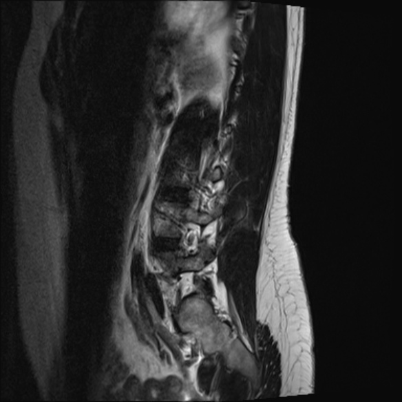 File:Normal lumbar spine MRI- 3 T (Radiopaedia 53280-59250 Sagittal T2 20).jpg
