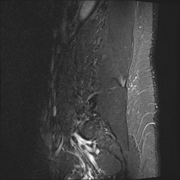 File:Normal lumbar spine MRI (Radiopaedia 47857-52609 Sagittal STIR 2).jpg