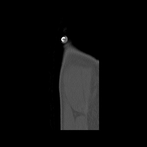 Normal pelvis (Radiopaedia 51473-57238 Sagittal bone window 147).jpg