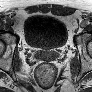 File:Normal prostate (MRI) (Radiopaedia 29986-30535 Axial T1 16).jpg