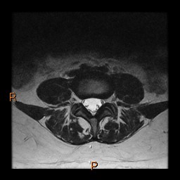 File:Normal spine MRI (Radiopaedia 77323-89408 Axial T2 15).jpg