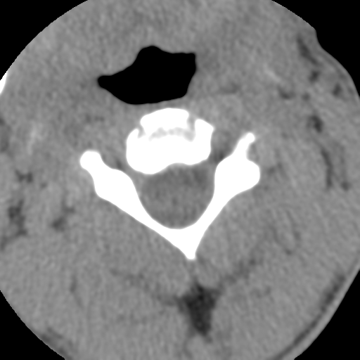 Normal trauma cervical spine (Radiopaedia 41017-43760 Axial non-contrast 21).png