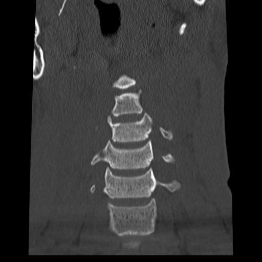 File:Normal trauma cervical spine (Radiopaedia 41017-43760 Coronal bone window 9).png