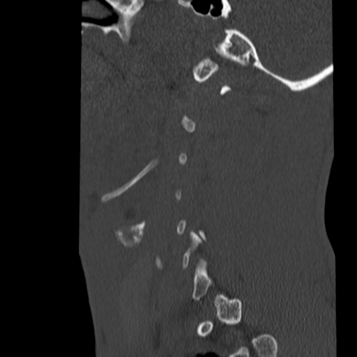 File:Normal trauma cervical spine (Radiopaedia 41017-43760 Sagittal bone window 5).png