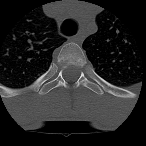 Normal trauma spine imaging (age 16) (Radiopaedia 45335-49358 Axial bone window 96).jpg
