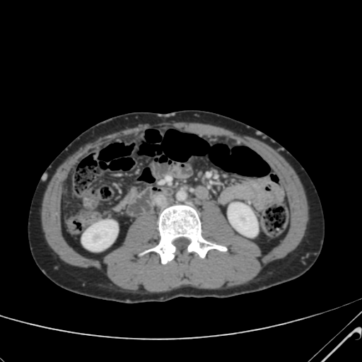 File:Nutmeg liver- Budd-Chiari syndrome (Radiopaedia 46234-50635 B 35).png
