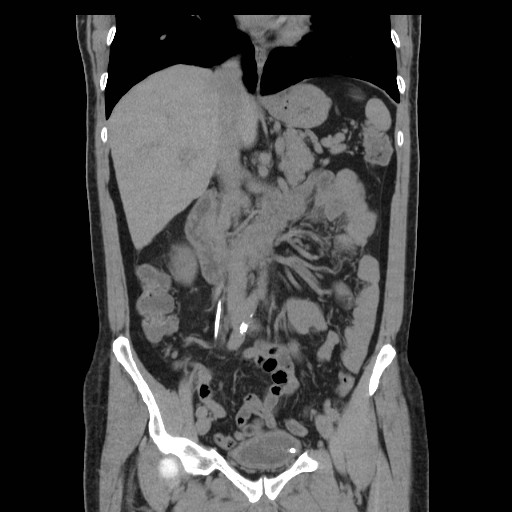 File:Obstructed kidney with perinephric urinoma (Radiopaedia 26889-27067 Coronal non-contrast 3).jpg